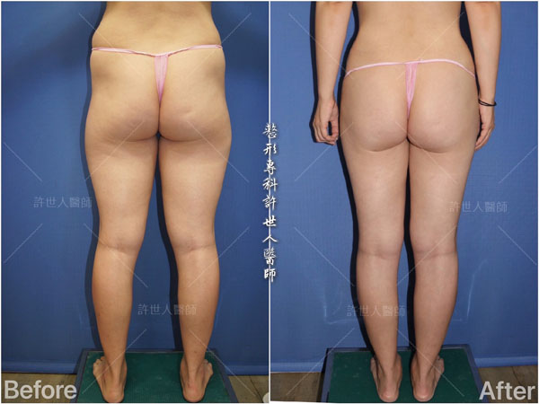 全身威塑VASER抽脂體雕+自體脂肪隆乳