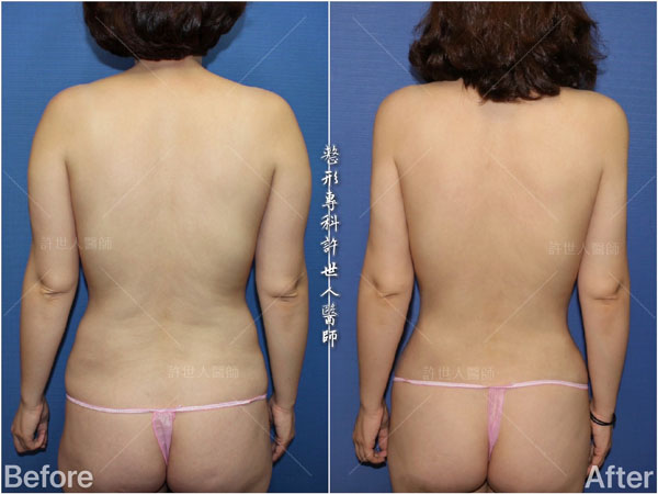 全身威塑VASER抽脂體雕+自體脂肪隆乳