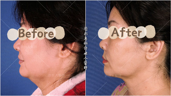 威塑VASER臉部下巴抽脂