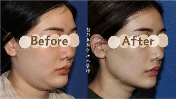 威塑VASER臉部下巴抽脂