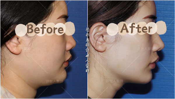 威塑VASER臉部下巴抽脂