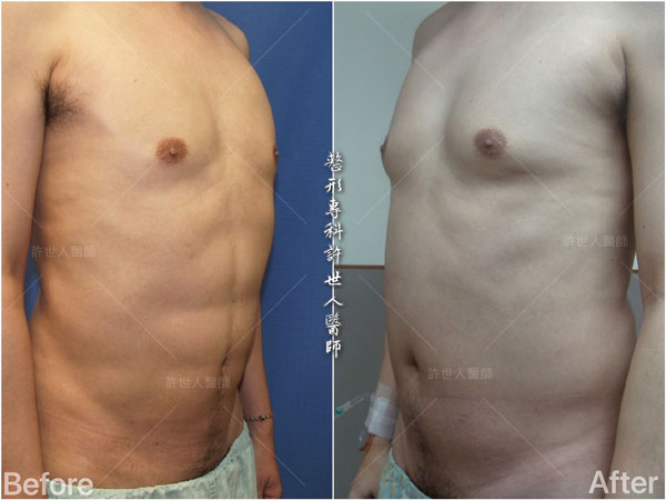 不必練,一次到位的懶人六塊肌和人魚線體雕整形術 ~ 26 威塑抽脂案例– 腰腹環抽+ 六塊肌雕塑