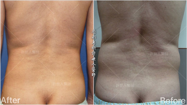 不必練,一次到位的懶人六塊肌和人魚線體雕整形術 ~ 28 威塑抽脂案例– 腰腹環抽+ 六塊肌雕塑