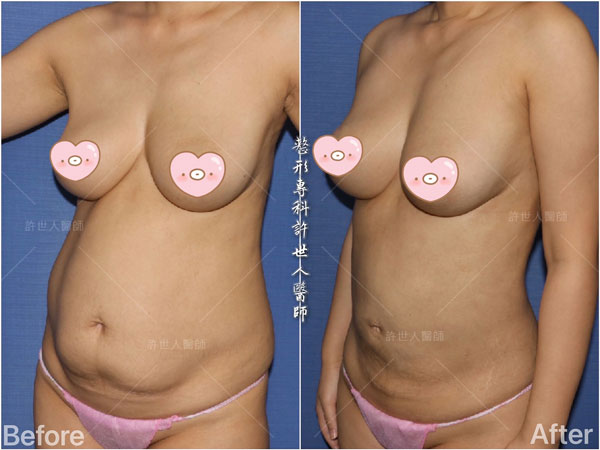 威塑抽脂案例– 腰腹環抽
