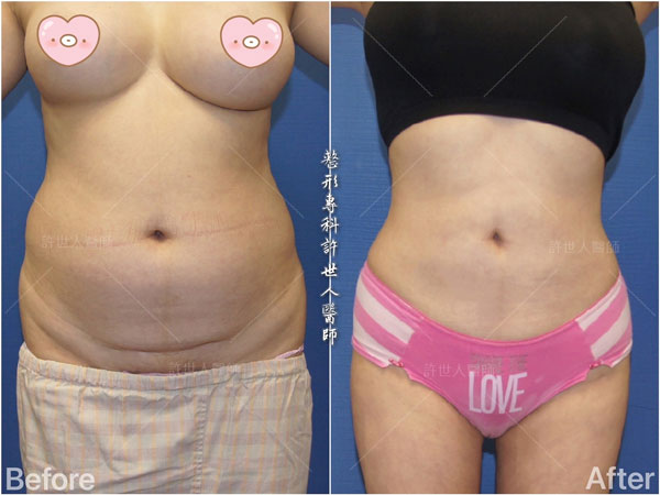 威塑抽脂案例– 腰腹環抽
