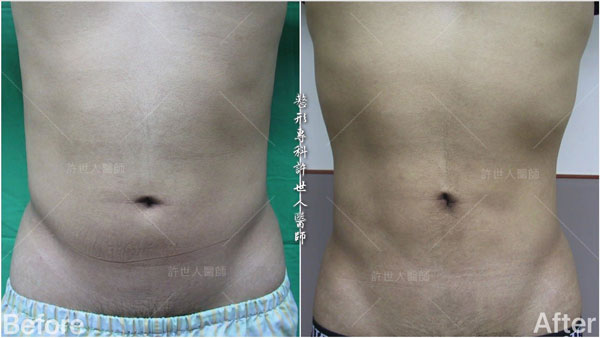 威塑抽脂案例– 腰腹環抽