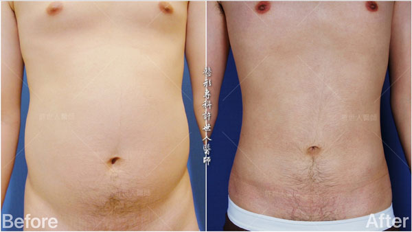 威塑抽脂案例– 腰腹環抽