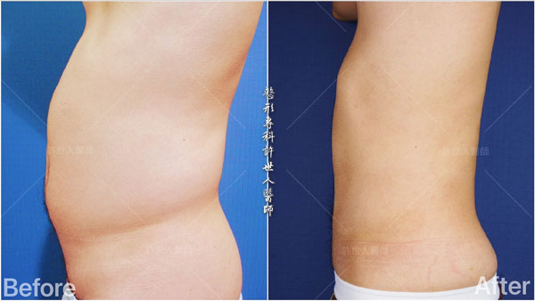 威塑抽脂案例– 腰腹環抽