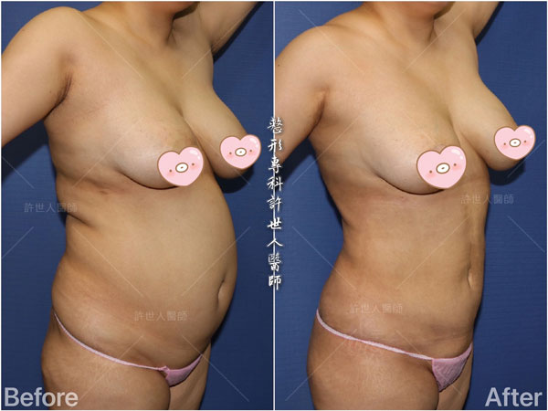 腹部抽脂案例3:威塑VASER抽脂體雕:腰腹環抽