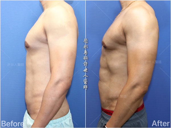 威塑抽脂案例– 腰腹環抽+ 六塊肌雕塑