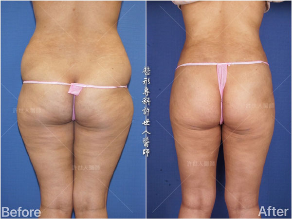 羅丹轉世? <全方位抽脂達人的誕生> 51 威塑抽脂案例– 腰腹環抽