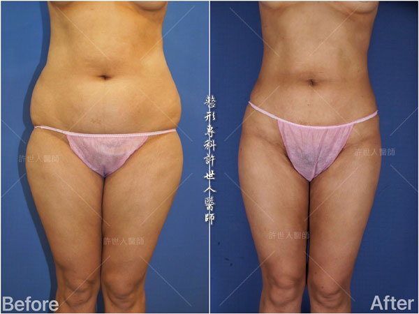 羅丹轉世? <全方位抽脂達人的誕生> 50 威塑抽脂案例– 腰腹環抽