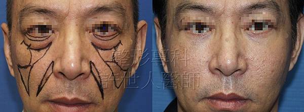 蘋果肌、臉頰補脂