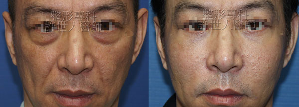 蘋果肌、臉頰補脂