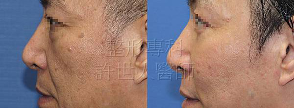 蘋果肌、臉頰補脂