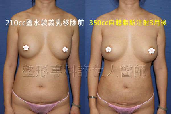 矽膠假體取出改自體脂肪隆乳6A