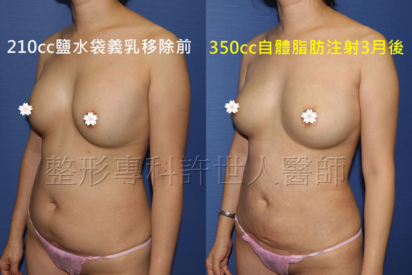 矽膠假體取出改自體脂肪隆乳6b