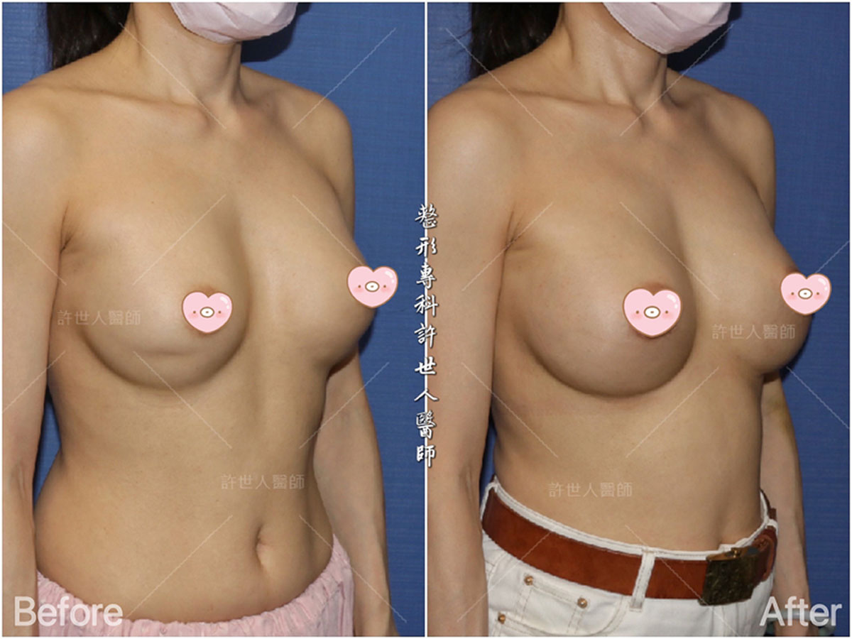 雙層奶和矽膠義乳破裂的二次隆乳重修+清除莢膜 (