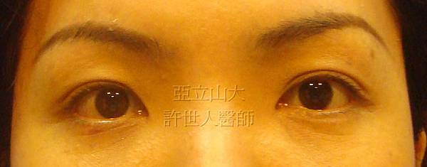 提眉手術+眼袋手術(內視鏡五爪鈎前額拉皮提眉術+眼袋內開脂肪移位填淚溝手術)