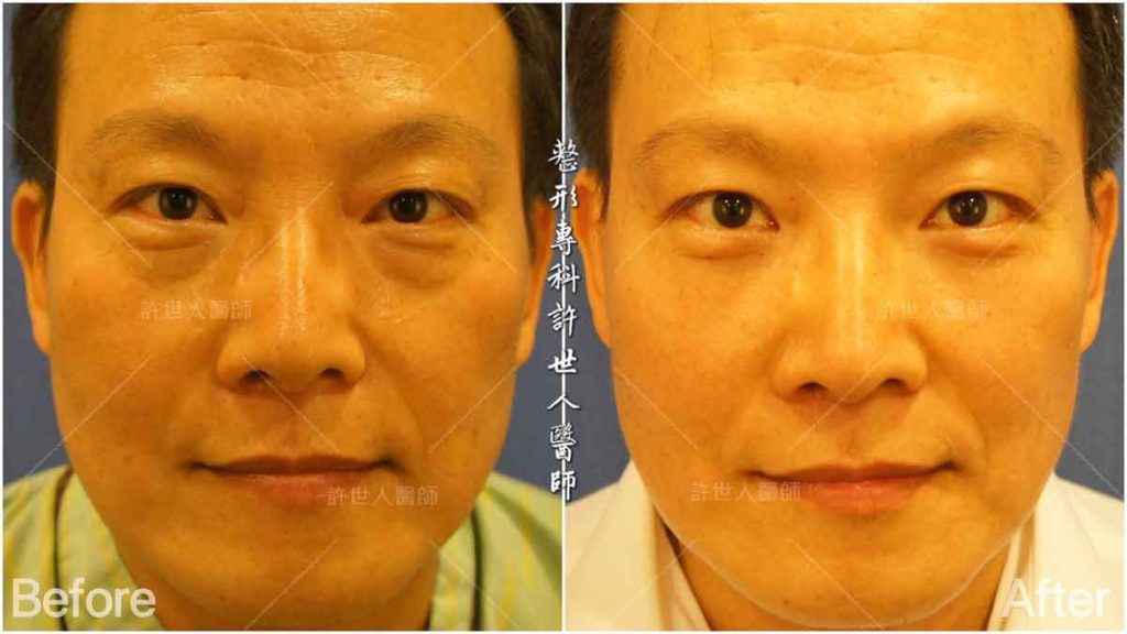 10內開六合一眼袋脂肪移位手術 (1) 眼袋內開脂肪移位手術 術前術後對照圖 許世人醫師案例分享
