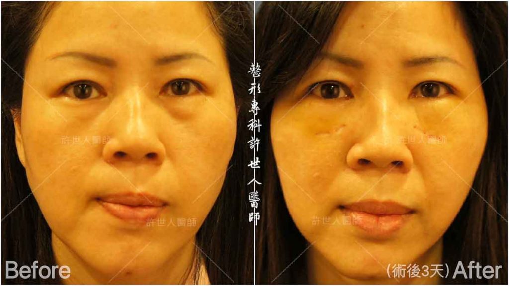 12內開六合一眼袋脂肪移位2_postop-3-d拼圖 眼袋內開脂肪移位手術 術前術後對照圖 許世人醫師案例分享