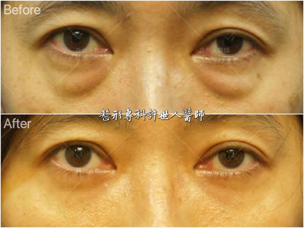 15內開六合一眼袋脂肪移位手術 (1) 沒有閃光燈,沒有表情時的術前術後對比照