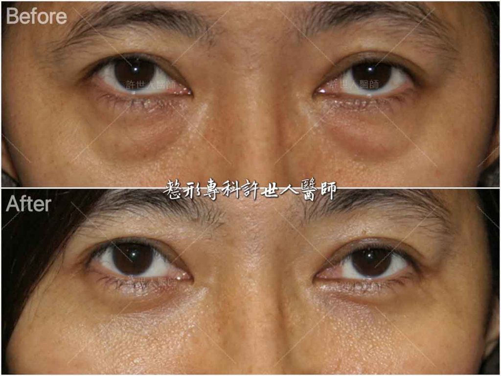 15內開六合一眼袋脂肪移位手術 (4) 沒有閃光燈,沒有表情時的術前術後對比照