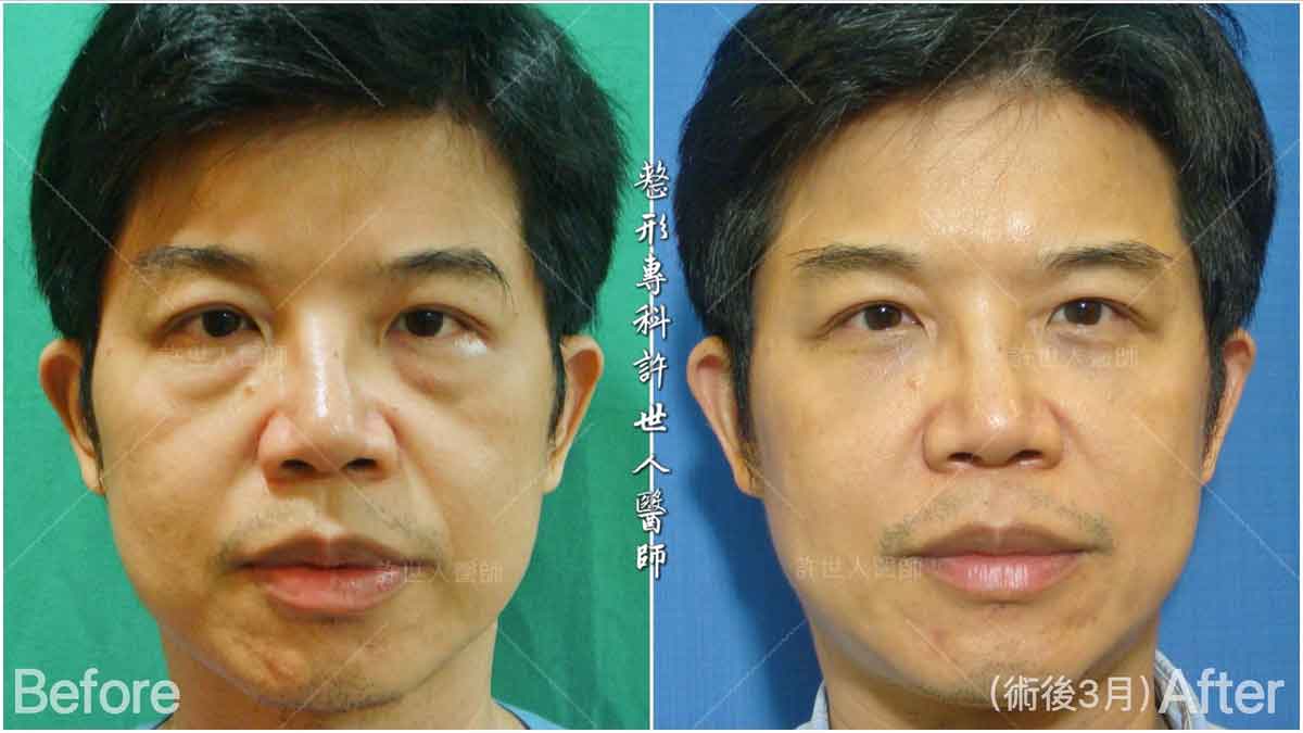 眼袋內開脂肪移位手術 術前術後對照圖 許世人醫師案例分享