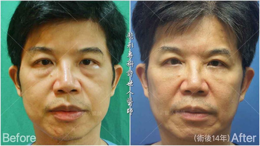 1內開六合一眼袋脂肪移位手術(3)_拼圖 眼袋內開脂肪移位手術 術前術後對照圖 許世人醫師案例分享