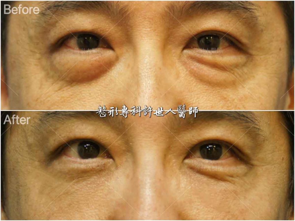 21內開六合一眼袋脂肪移位手術 (1)