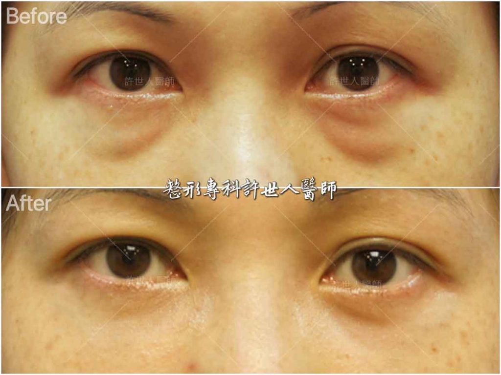 26內開六合一眼袋脂肪移位手術 (1) 眼袋內開脂肪移位手術 術前術後對照圖 許世人醫師案例分享