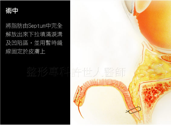 眼袋內開,眼袋脂肪移位手術圖解說明