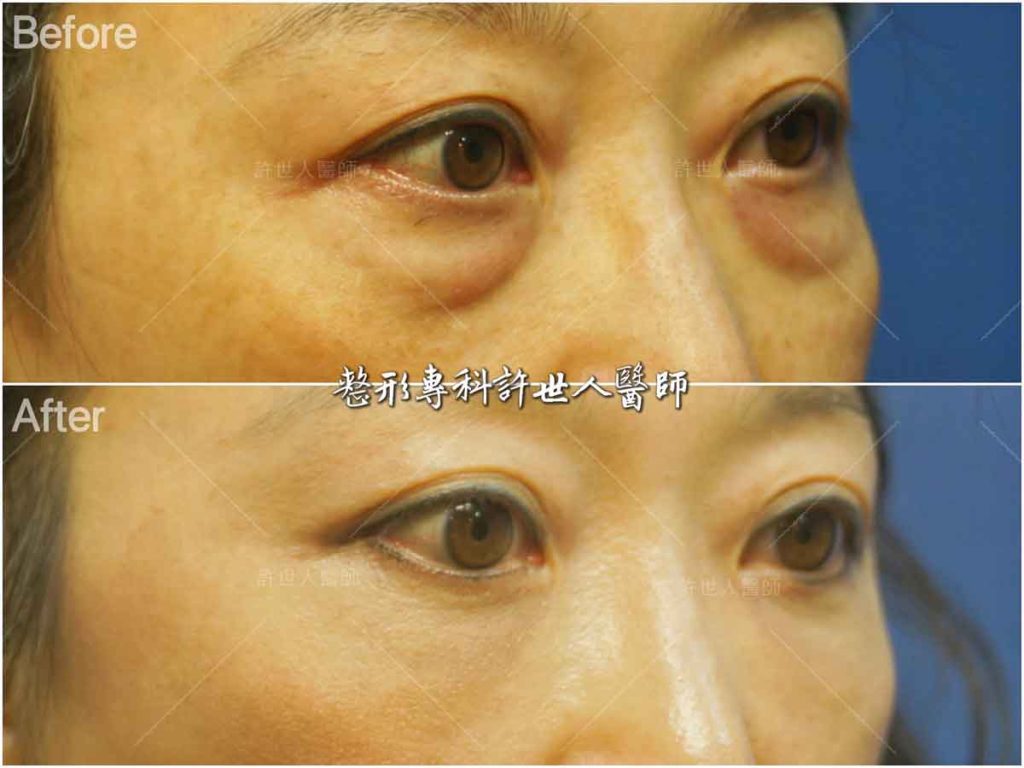 眼袋內開脂肪移位手術 術前術後對照圖 許世人醫師案例分享