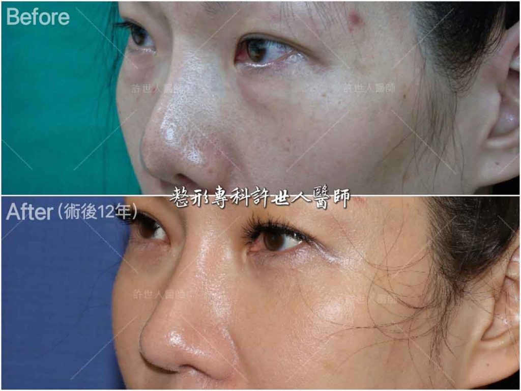 5內開六合一眼袋脂肪移位手術4-postop-12yrs 眼袋內開脂肪移位手術 術前術後對照圖 許世人醫師案例分享
