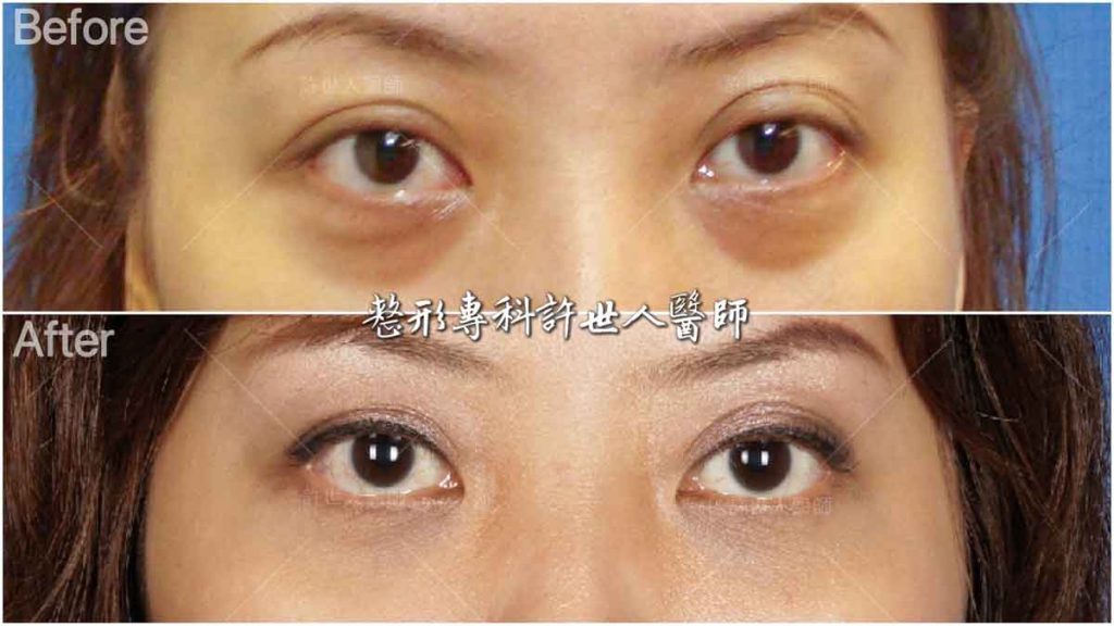 8內開六合一眼袋脂肪移位手術 (2) 眼袋內開脂肪移位手術 術前術後對照圖 許世人醫師案例分享