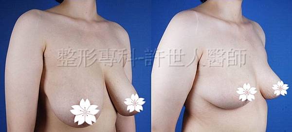 縮乳提乳術案例_(棒棒糖式短疤縮乳提乳手術)