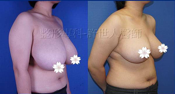棒棒糖式短疤縮胸提乳手術
