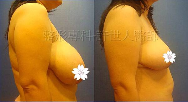 縮乳提乳(許世人醫師案例)