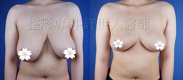 縮乳提乳案例(棒棒糖式短疤縮乳提乳手術)