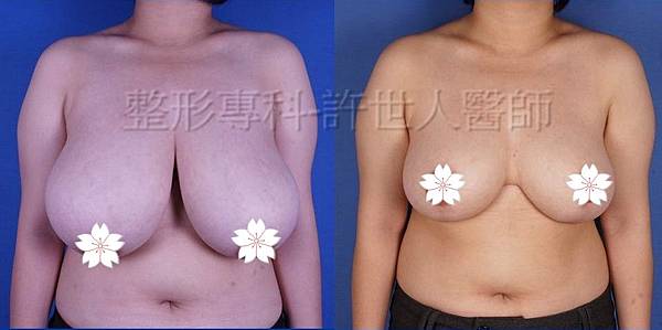 縮乳提乳術案例