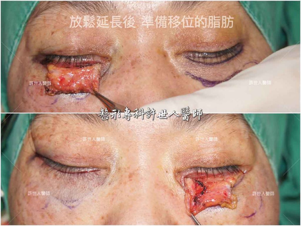外開眼袋脂肪移位手術案例 放鬆延長後 準備移位的眼袋脂肪