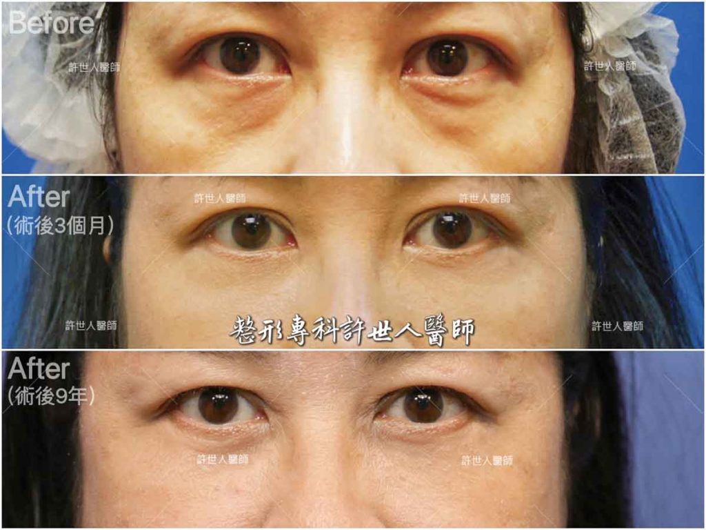 外開眼袋脂肪移位手術案例 術前 vs 3個月 vs 9年