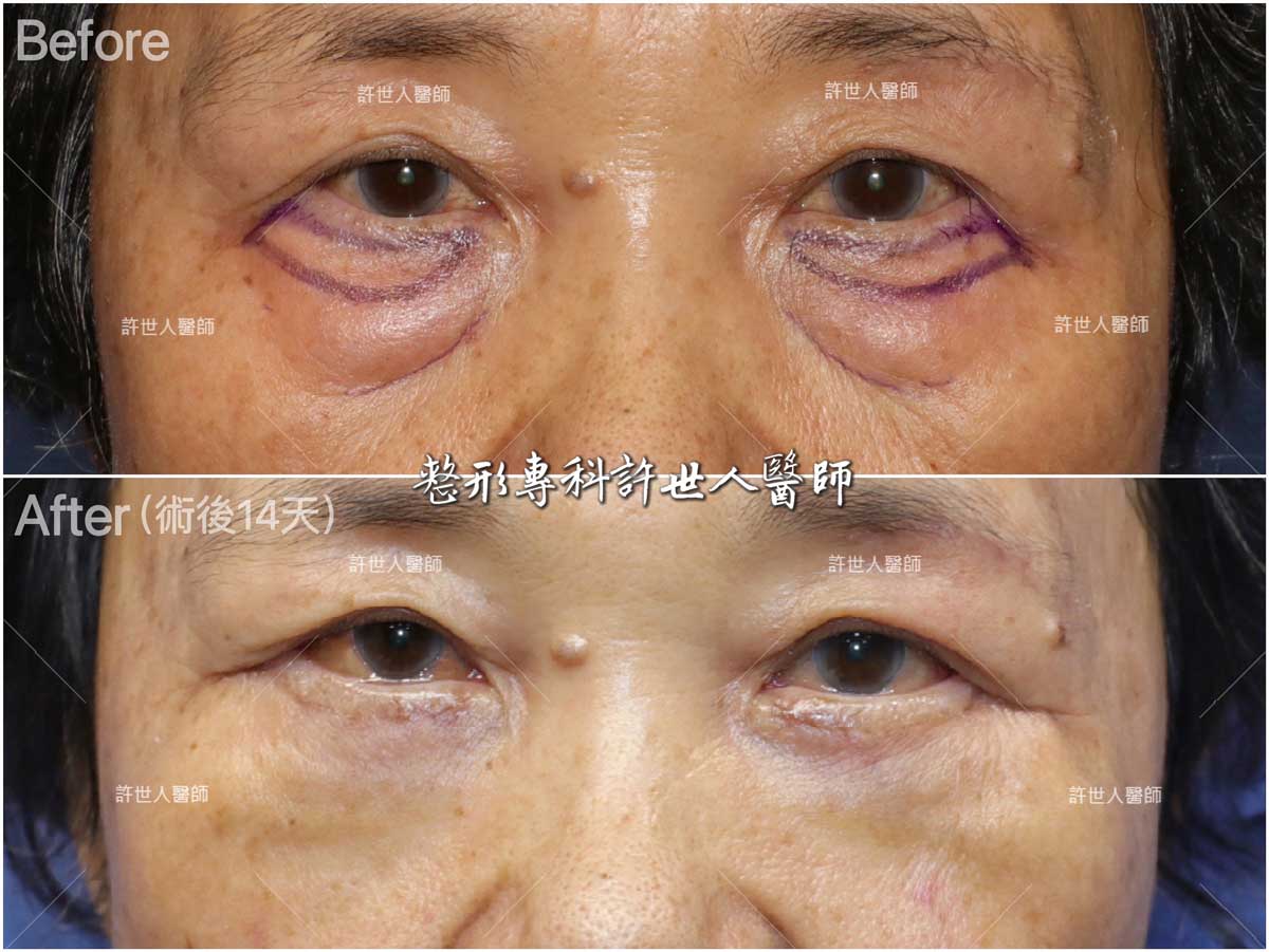 1眼袋外開脂肪移位手術6 術前vs-術後14天 外開眼袋脂肪移位手術案例 術前vs 術後7天