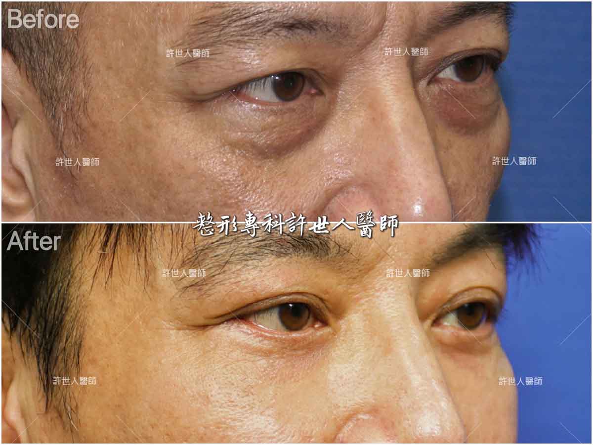4眼袋外開手術案例2 外開眼袋脂肪移位手術案例