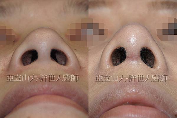 隆鼻推薦:結構式隆鼻 (許世人醫師案例分享)