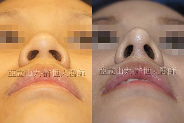 三段結構式隆鼻,術後2年