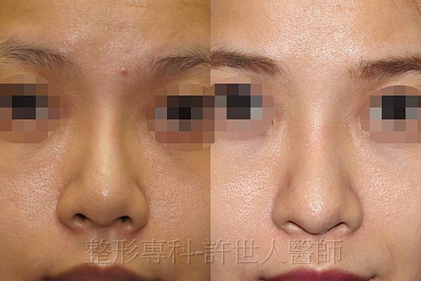 三段結構式隆鼻 ,術後6個月