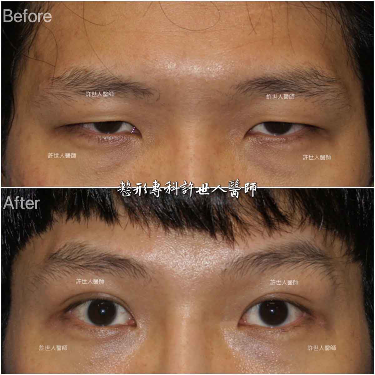 內視鏡五爪鈎提眉+提眼瞼肌手術+訂書機雙眼皮手術許世人醫師案例分享