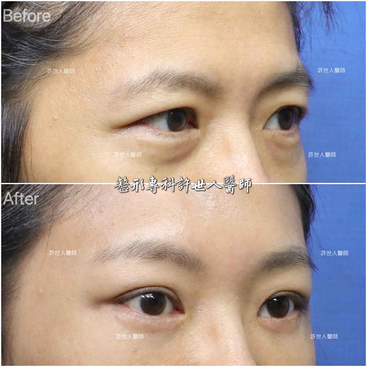 內視鏡五爪鈎提眉＋外開眼袋脂肪移位手術許世人醫師案例分享