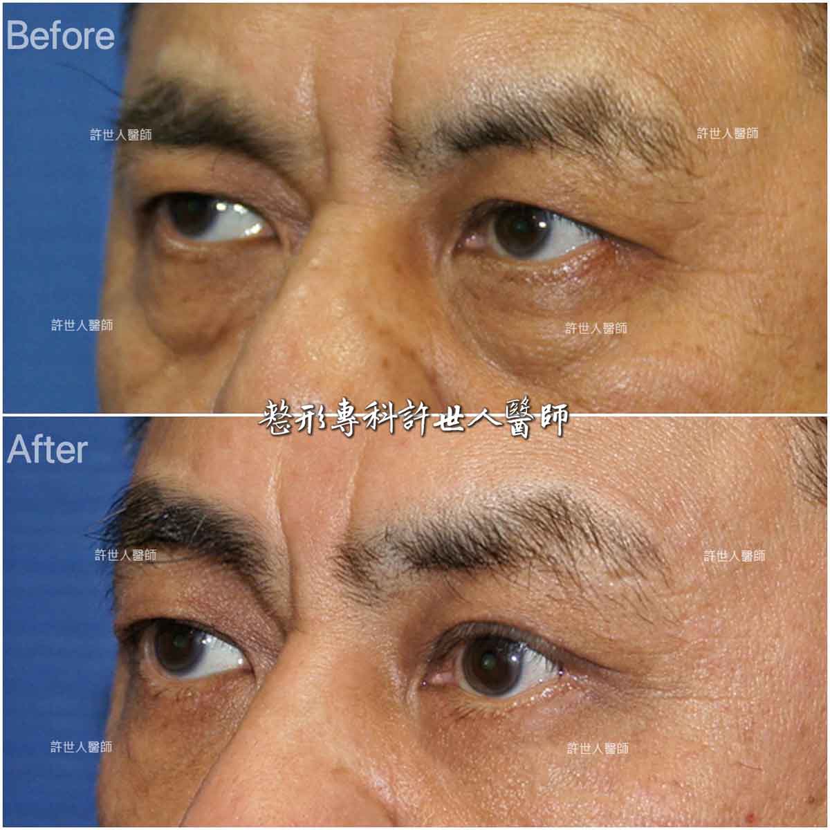 內視鏡五爪鈎前額拉皮提眉術+眼袋外開脂肪移位填淚溝手術